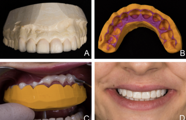 Augmenter les taux d’acceptation des gros devis : L’importance de l’émotion et du mock-up en dentisterie
