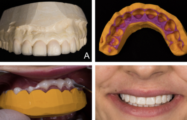 Augmenter les taux d’acceptation des gros devis : L’importance de l’émotion et du mock-up en dentisterie