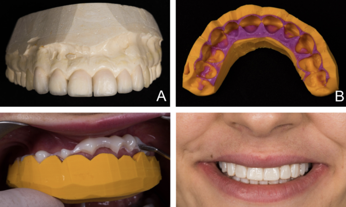 Augmenter les taux d’acceptation des gros devis : L’importance de l’émotion et du mock-up en dentisterie